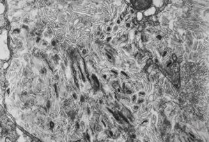 Whipple disease Whipple disease